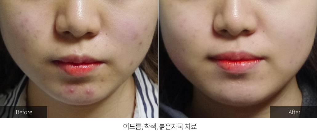 여드름, 착색, 붉은자국 치료