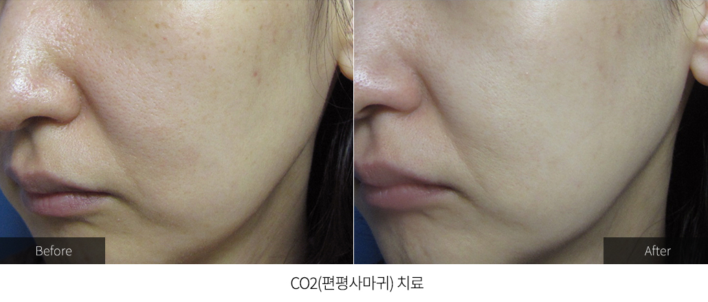 CO2(편평사마귀) 치료