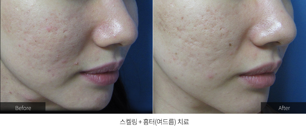 스켈링 + 여드름흉터 치료